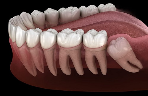 Wisdom Tooth Extraction 1