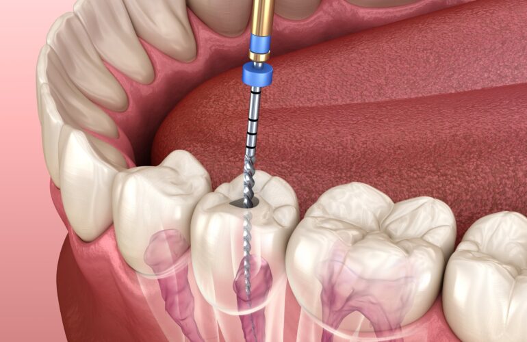 cc dental root canal diagram