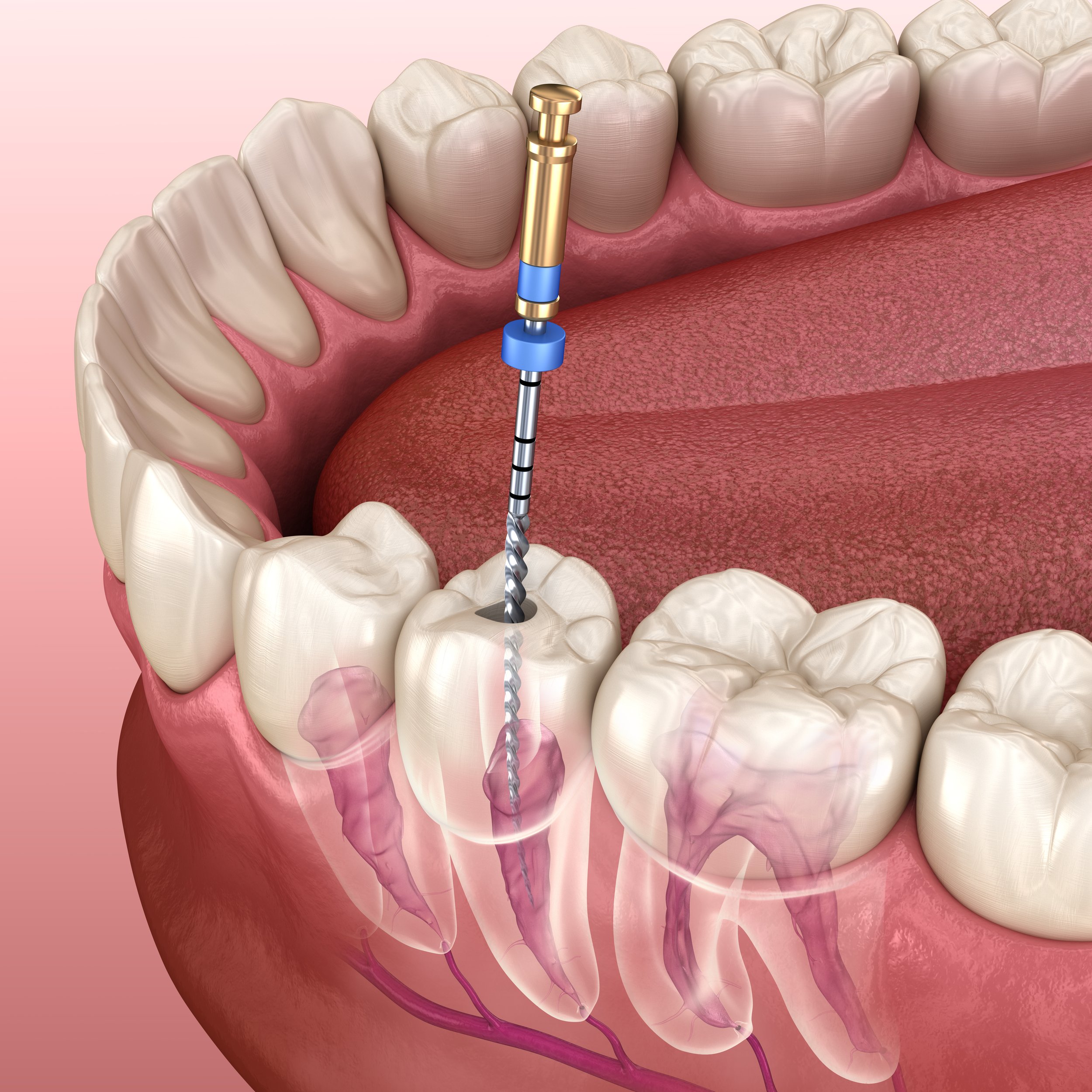 cc dental root canal diagram