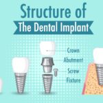 infographic human structure dental implant 1308 92949