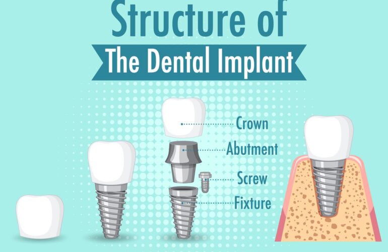 infographic human structure dental implant 1308 92949