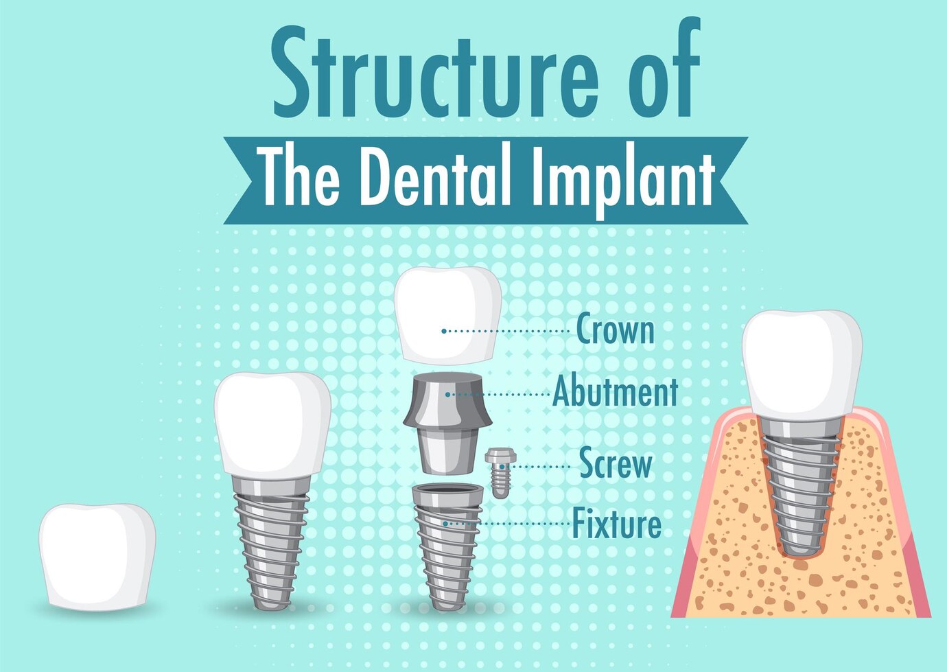 infographic human structure dental implant 1308 92949