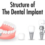 Structure of the dental implant on white background