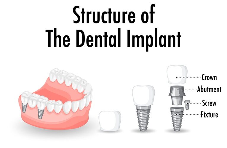 Structure of the dental implant on white background